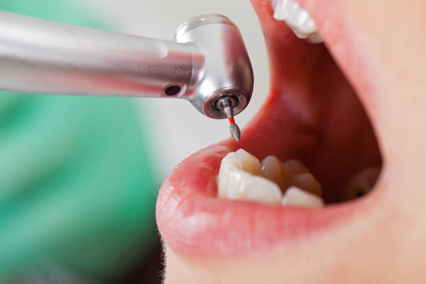 Best Emergency Dentist for Lost Fillings or Crowns in Horse Pasture, VA